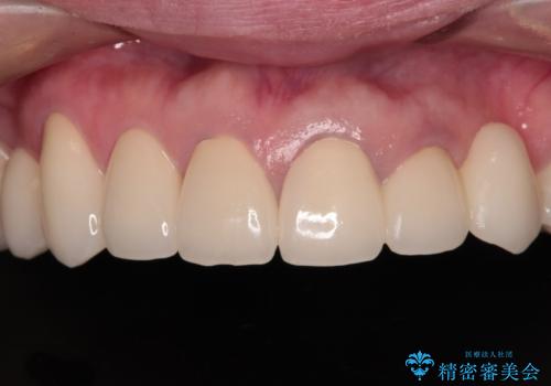 欠損やむし歯の歯をきれいなセラミックに　全顎虫歯治療