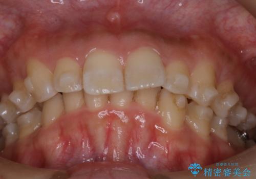 上の出っ歯を治したい インビザラインによる矯正治療の治療中
