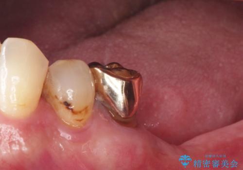 【インプラント】銀歯が取れて歯ごと折れたの治療前