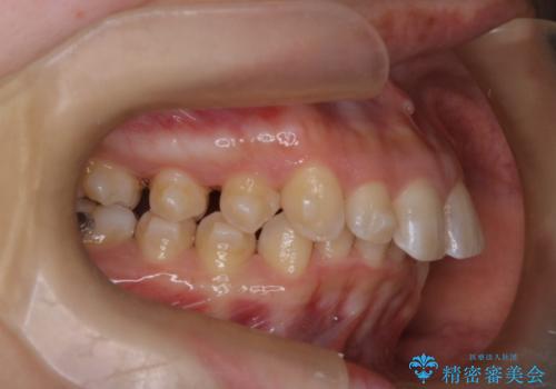 上の出っ歯を治したい　インビザラインによる矯正治療の治療中