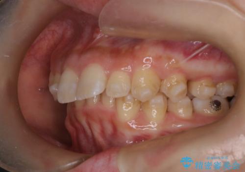 上の出っ歯を治したい インビザラインによる矯正治療の治療中