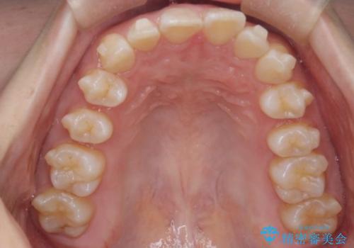 上の出っ歯を治したい インビザラインによる矯正治療の治療中