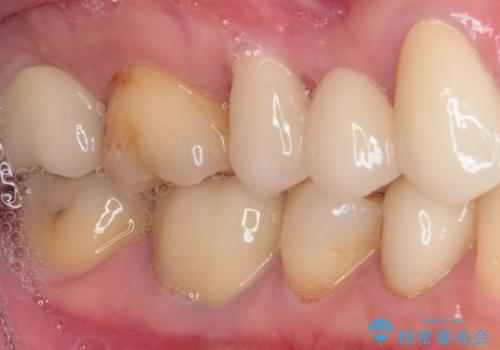欠損やむし歯の歯をきれいなセラミックに 全顎虫歯治療の治療後