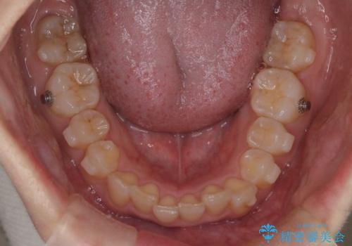 上の出っ歯を治したい インビザラインによる矯正治療の治療中