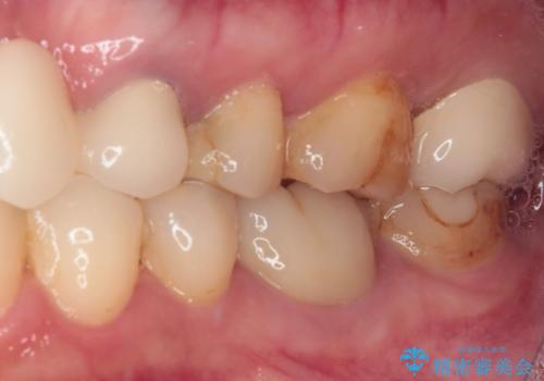 欠損やむし歯の歯をきれいなセラミックに 全顎虫歯治療の治療後