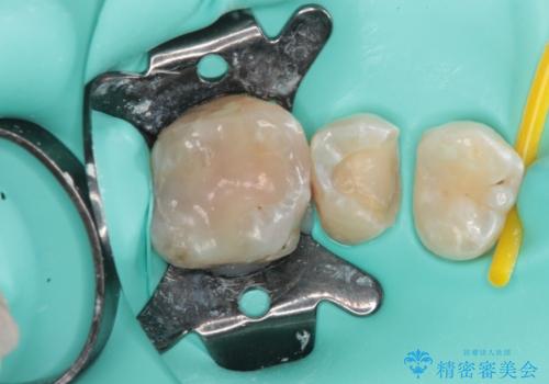 奥歯に物が挟まる　セラミックインレーによる虫歯治療の治療中