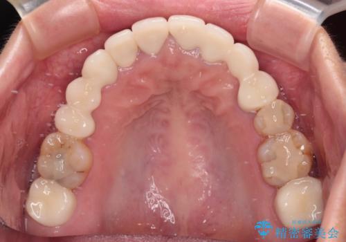 欠損やむし歯の歯をきれいなセラミックに 全顎虫歯治療の治療後