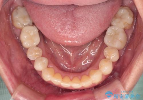欠損やむし歯の歯をきれいなセラミックに 全顎虫歯治療の治療後