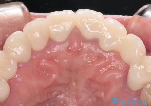 欠損やむし歯の歯をきれいなセラミックに 全顎虫歯治療の治療後