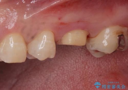 フルジルコニアクラウンの治療中