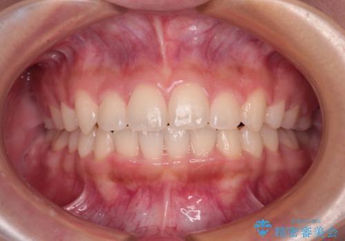 前に出てきた歯列を改善 ワイヤー装置での再矯正治療の症例 治療後