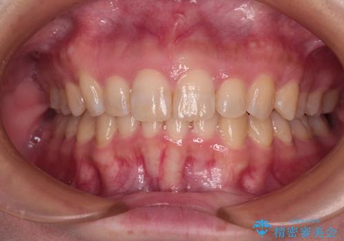 上の出っ歯を治したい インビザラインによる矯正治療の症例 治療後