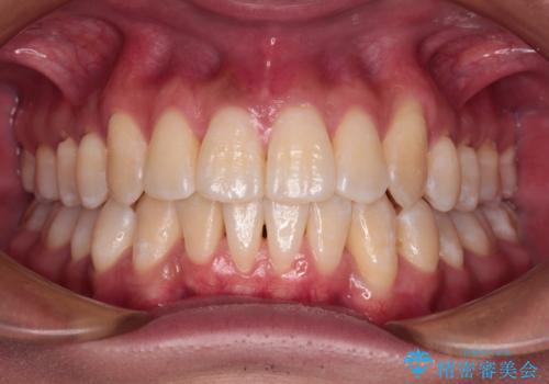 補助装置を併用してスムーズに インビザラインによる矯正治療の症例 治療後