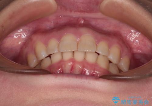 上の出っ歯を治したい インビザラインによる矯正治療の治療後