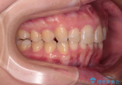 上の出っ歯を治したい インビザラインによる矯正治療の治療後