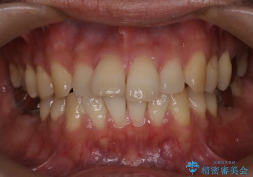 短期間で口元の印象をガラリと変えませんか? 30代男性 インビザライン矯正で自然な口元美を実現の症例 治療前