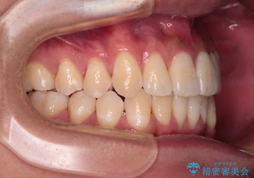 補助装置を併用してスムーズに インビザラインによる矯正治療の治療後