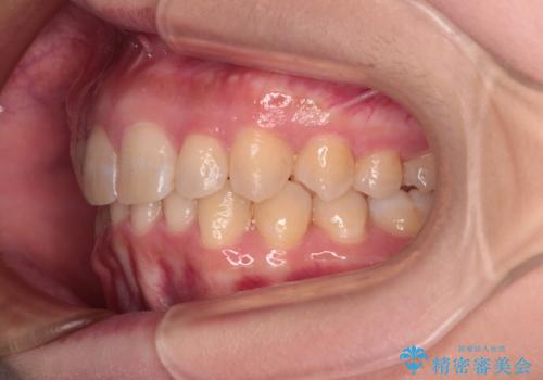 上の出っ歯を治したい　インビザラインによる矯正治療の治療後