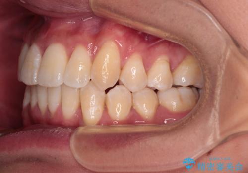 補助装置を併用してスムーズに インビザラインによる矯正治療の治療後