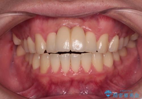 下顎前歯の部分矯正　目立たないワイヤー装置の症例 治療後