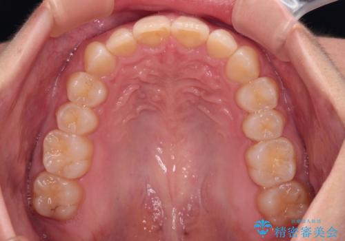 上の出っ歯を治したい インビザラインによる矯正治療の治療後