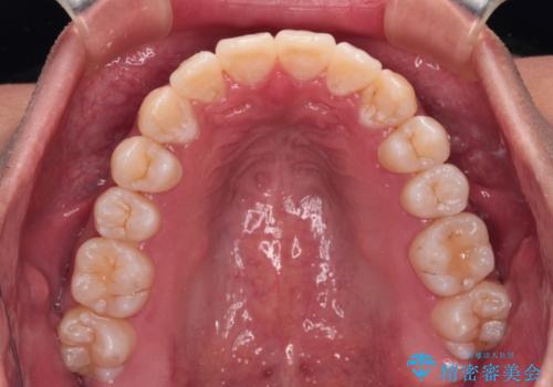 補助装置を併用してスムーズに インビザラインによる矯正治療の治療後