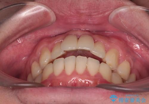 下顎前歯の部分矯正 目立たないワイヤー装置の治療後