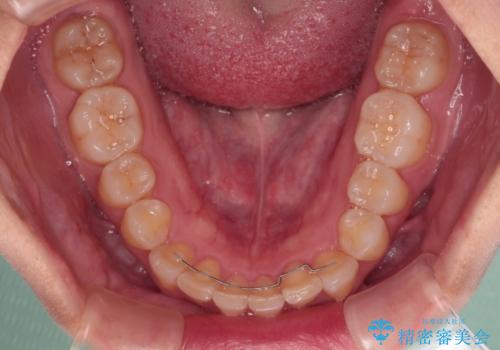 上の出っ歯を治したい　インビザラインによる矯正治療の治療後