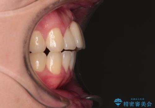 下顎前歯の部分矯正 目立たないワイヤー装置の治療後
