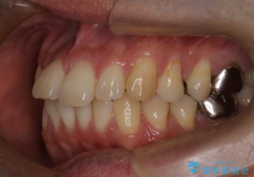 短期間で口元の印象をガラリと変えませんか? 30代男性 インビザライン矯正で自然な口元美を実現の治療前