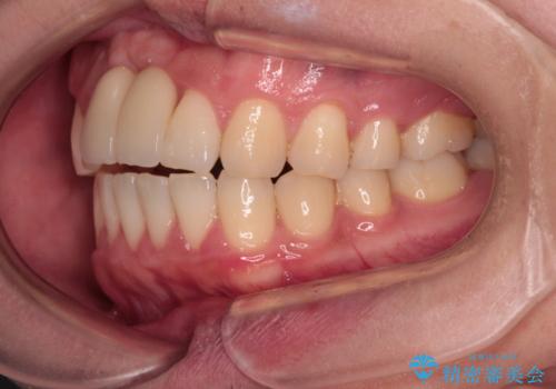 下顎前歯の部分矯正　目立たないワイヤー装置の治療後
