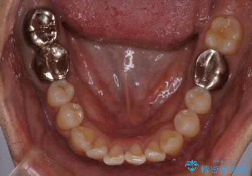 短期間で口元の印象をガラリと変えませんか? 30代男性 インビザライン矯正で自然な口元美を実現の治療前