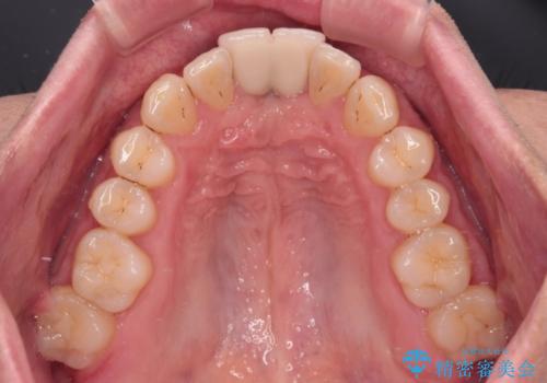 下顎前歯の部分矯正　目立たないワイヤー装置の治療後