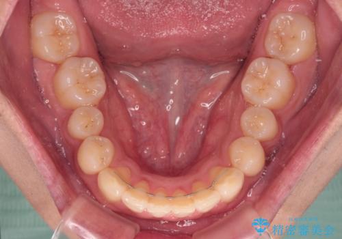 下顎前歯の部分矯正 目立たないワイヤー装置の治療後
