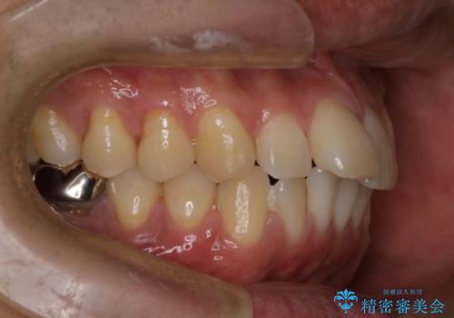 短期間で口元の印象をガラリと変えませんか? 30代男性 インビザライン矯正で自然な口元美を実現の治療前