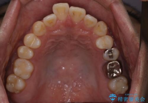 短期間で口元の印象をガラリと変えませんか? 30代男性 インビザライン矯正で自然な口元美を実現の治療前