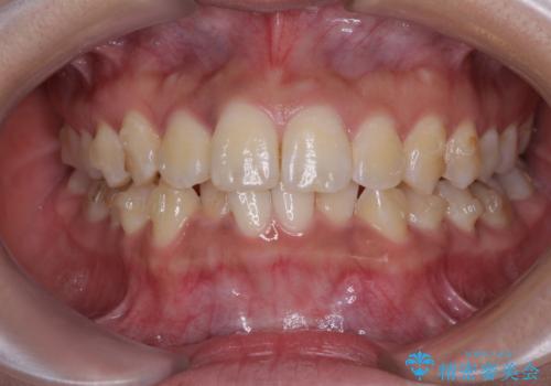 前歯のデコボコと隠れてしまう下顎前歯　インビザラインですっきりと改善の治療中