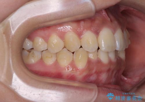 前歯のデコボコと隠れてしまう下顎前歯 インビザラインですっきりと改善の治療中