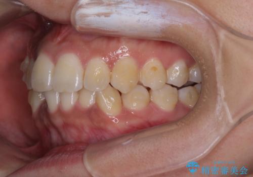 前歯のデコボコと隠れてしまう下顎前歯 インビザラインですっきりと改善の治療中