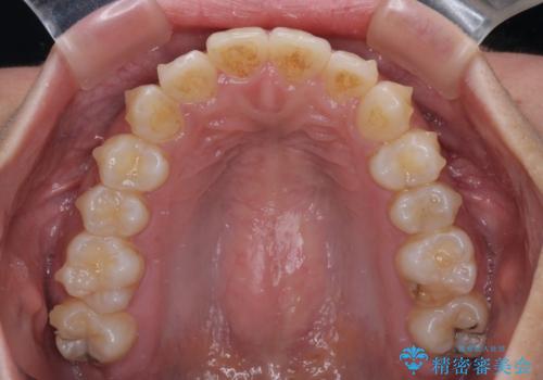 前歯のデコボコと隠れてしまう下顎前歯 インビザラインですっきりと改善の治療中