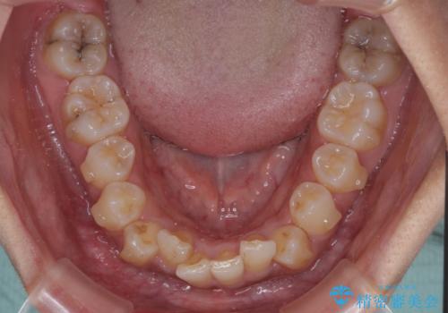 前歯のデコボコと隠れてしまう下顎前歯　インビザラインですっきりと改善の治療中