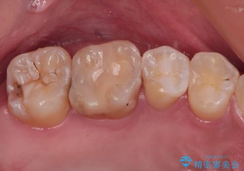 奥歯に物が挟まる　セラミックインレーによる虫歯治療の症例 治療後