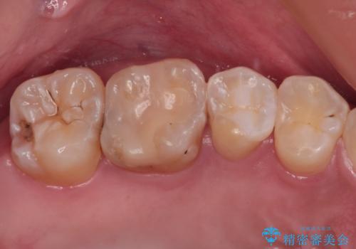 奥歯に物が挟まる　セラミックインレーによる虫歯治療の治療後