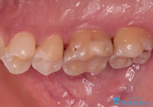 奥歯に物が挟まる セラミックインレーによる虫歯治療の治療後