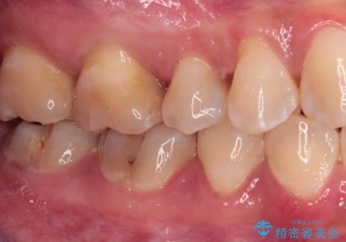 奥歯に物が挟まる セラミックインレーによる虫歯治療の治療後