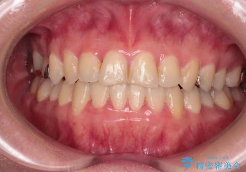 気になる歯列不正とむし歯を治療　インビザライン治療と虫歯治療の症例 治療後