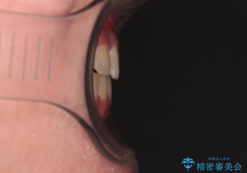 気になる歯列不正とむし歯を治療 インビザライン治療と虫歯治療の治療後