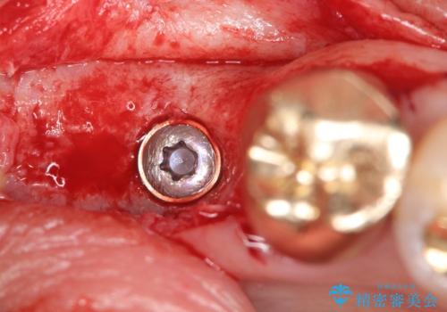 【インプラント】銀歯が取れて歯ごと折れたの治療中