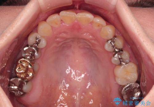 気になる歯列不正とむし歯を治療　インビザライン治療と虫歯治療の治療後