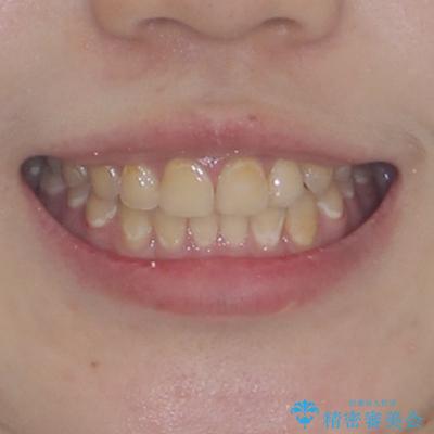 前歯のクロスバイトを改善 ワイヤー矯正を併用したインビザライン矯正の治療後(顔貌)